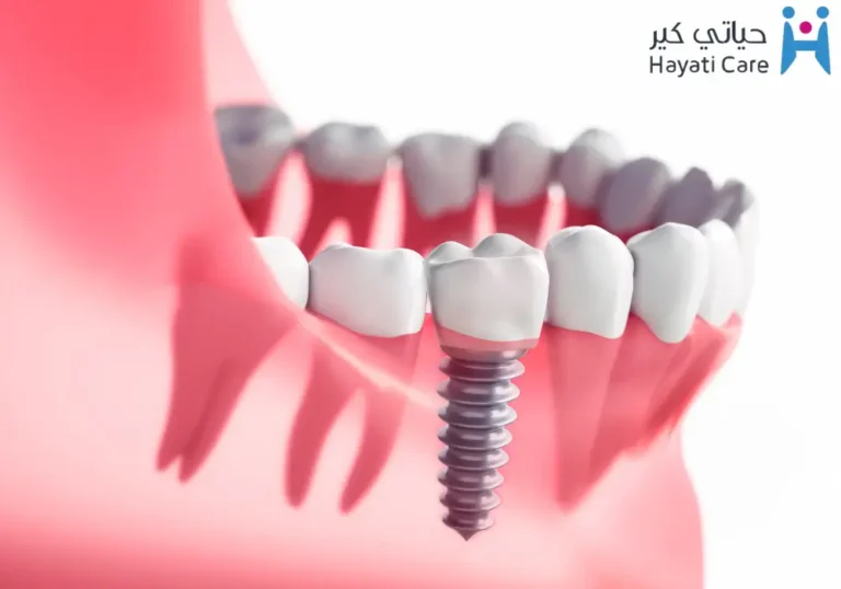 سعر زراعة الأسنان:تعرف علي التكلفة والخدمات المميزة في مجمع حياتي كير الطبي بصبيا