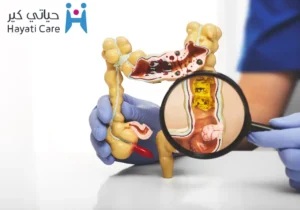 أفضل طرق علاج القولون العصبى